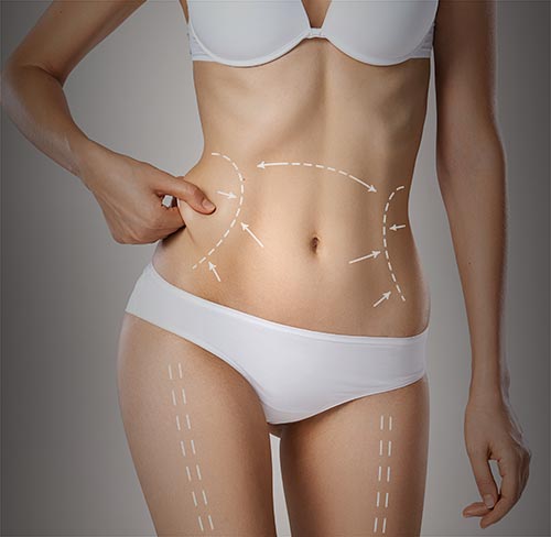 Liposuction